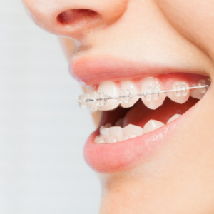 What is the average cost of ceramic braces?